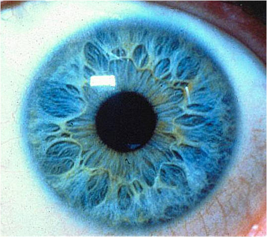 Iridology Picture of a Weak Constitution