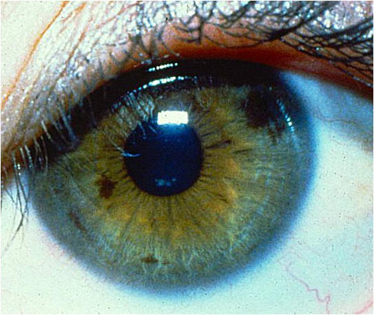 Iridology Picture of Chemical (Drug) Spots